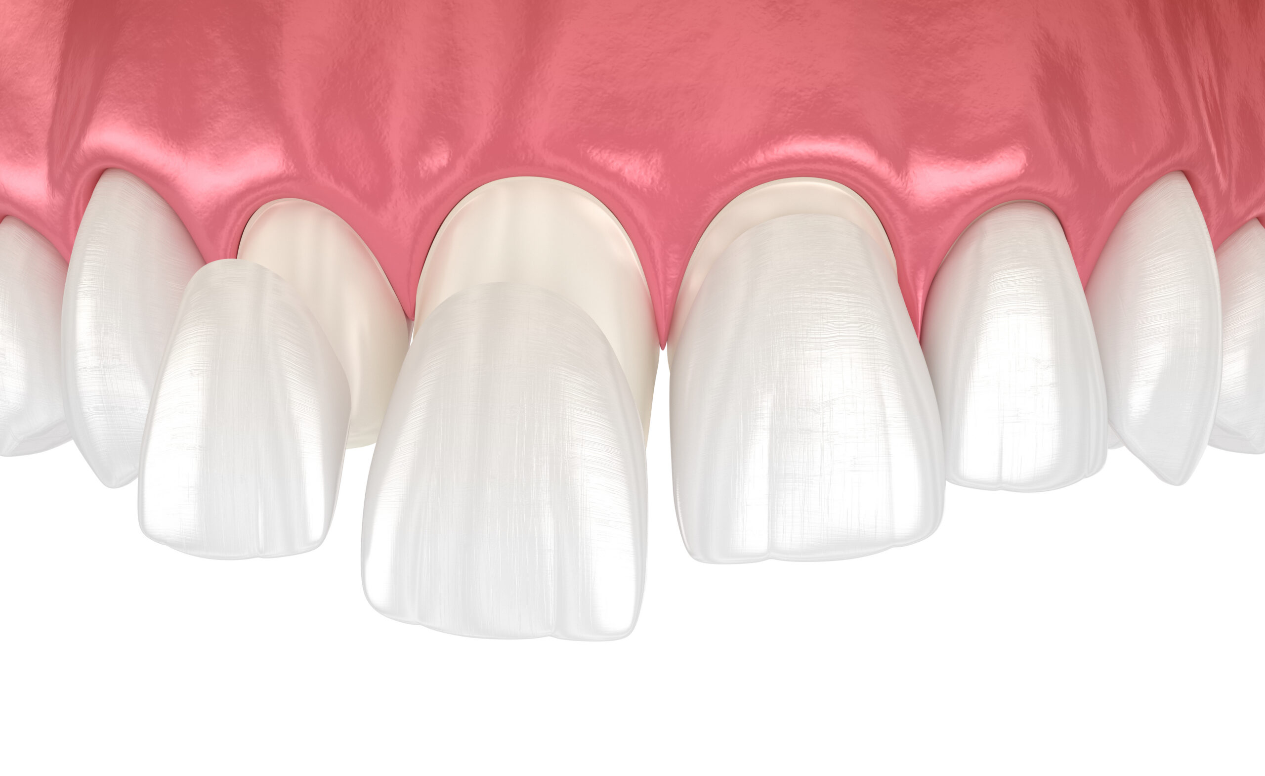 Dental veneers on blue background. 3D illustration