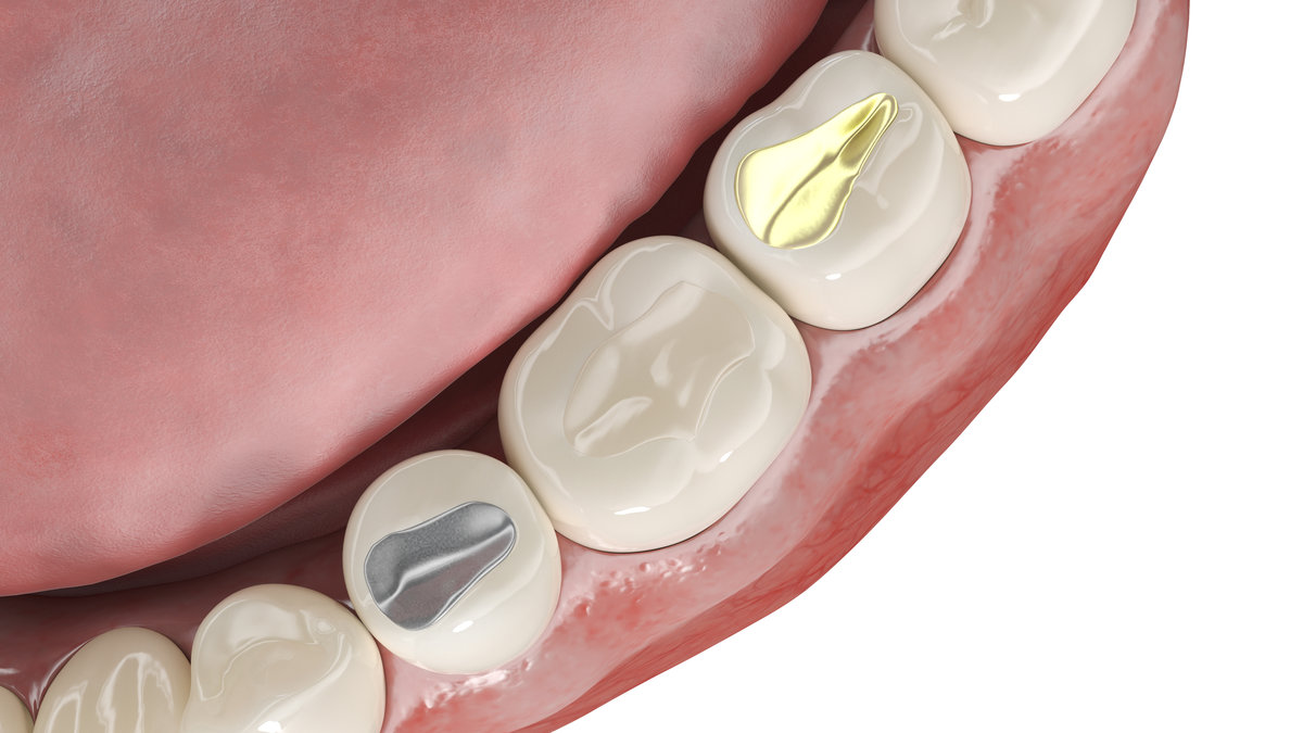 3d rendered illustration of different dental fillings