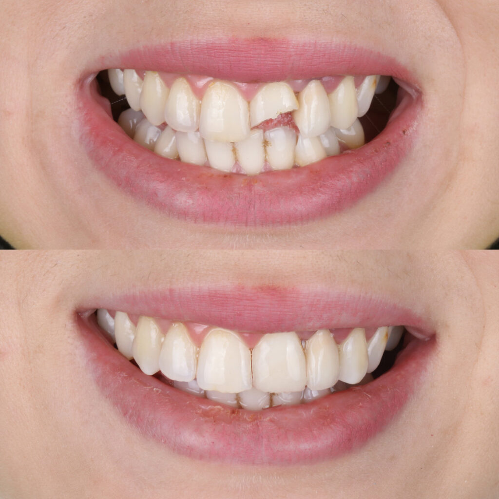 Treatment of deformed and discolored teeth with composite filling in dental care. Filling treatment for decayed teeth. Dental before after and smile makeover.